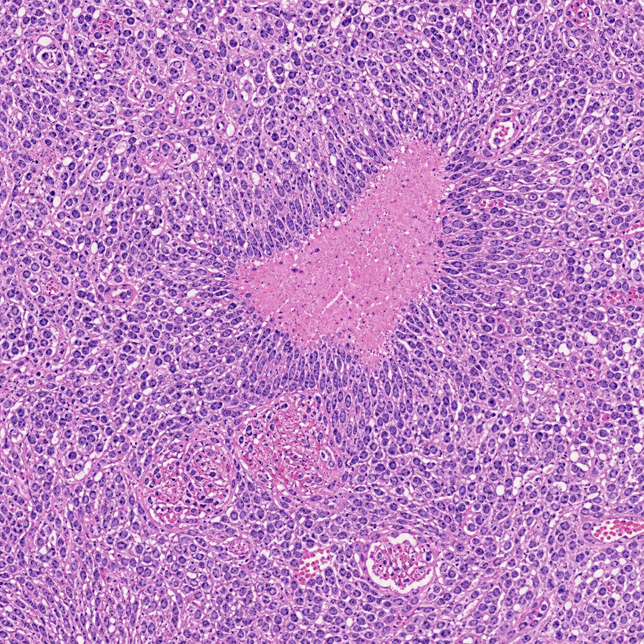 Synthetic glioblastoma H and E microscopic field